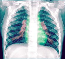 Chest x-ray of a 3 year old female baby by PhotoStock-Isra