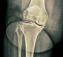 x-ray of the right knee by PhotoStock-Isra